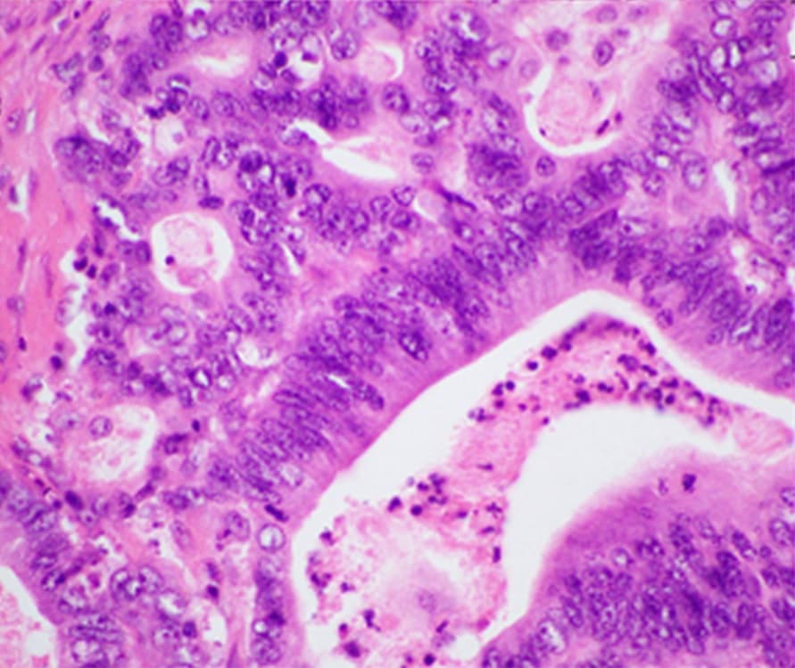 Microscope image of pancreatic ductal adenocarcinoma, the tumour type treated in the RASolute 302 trial